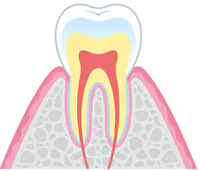 c0（初期虫歯）