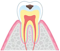 c1（エナメル質の虫歯）