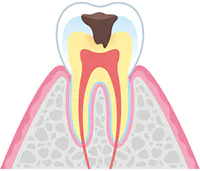 c2（象牙質の虫歯）