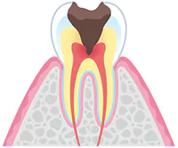 c3（神経まで達した虫歯）