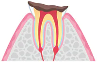 c4（歯根まで達した虫歯）
