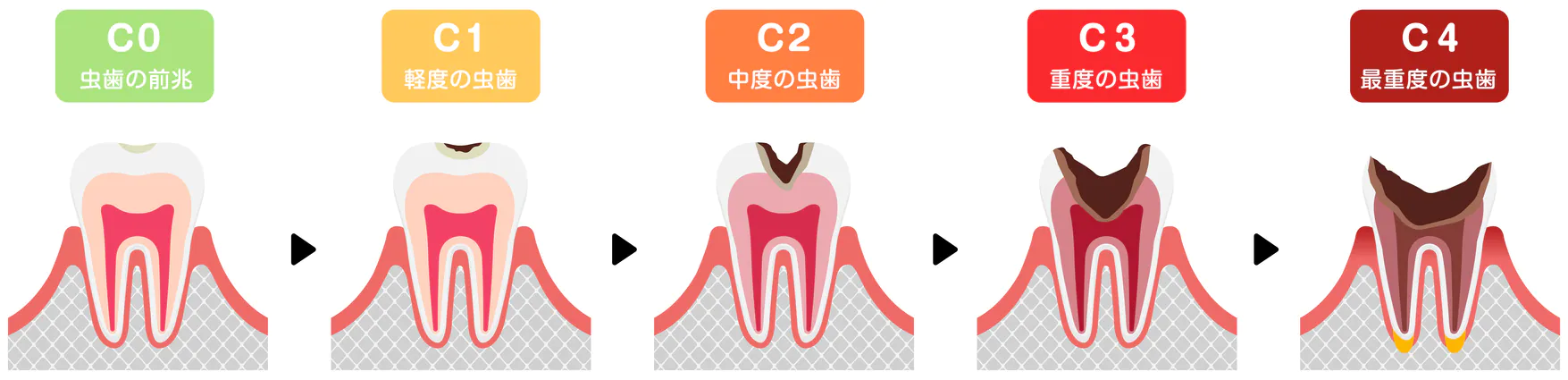 そもそも虫歯になる原因は？