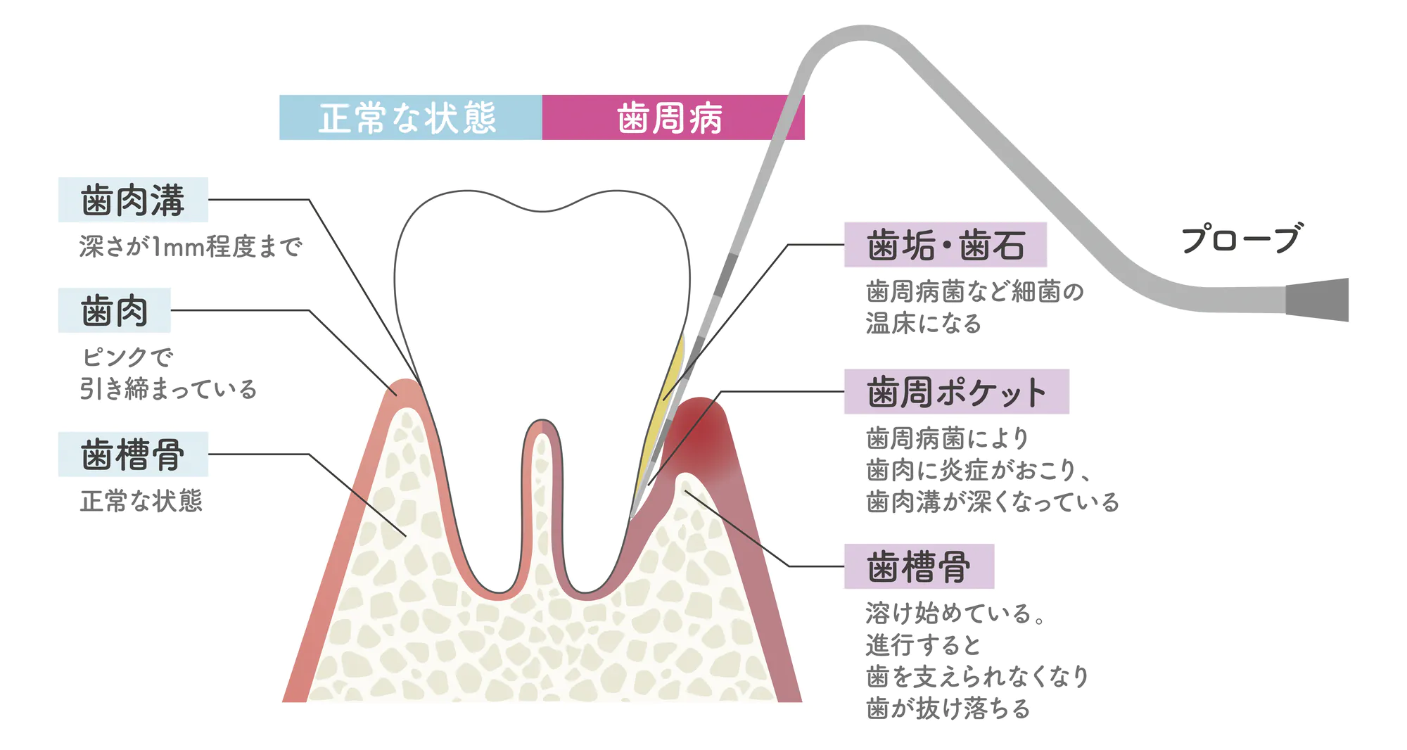 歯周病の原因