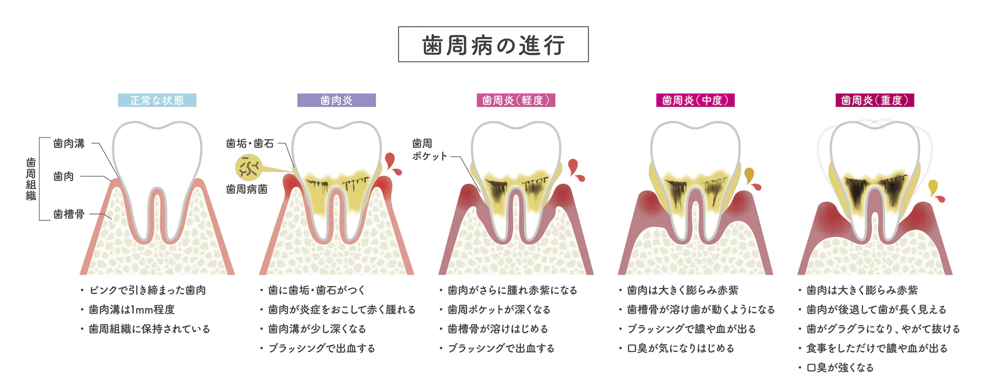 歯周病の進行