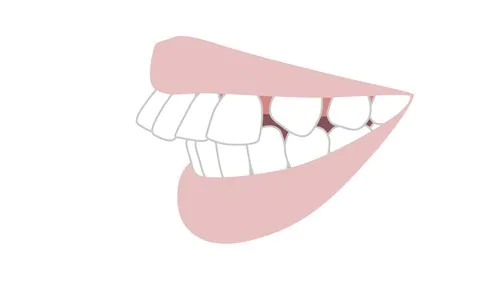 出っ歯（上顎前突）である