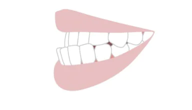 受け口（反対咬合）である
